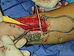 ورم العصب في القدم والكاحل: دليل شامل وخبرة الأستاذ الدكتور محمد هطيف في صنعاء