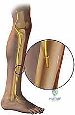 TECH FIG 6  Drilling unicortical hole in fibula for transected superior peroneal nerve ending