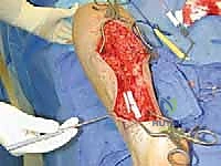 TECH FIG 6  Drilling unicortical hole in fibula for transected superior peroneal nerve ending