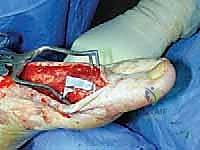 TECH FIG 9  Saphenous nerve neuroma and small anterior branch