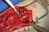 TECH FIG 9  Saphenous nerve neuroma and small anterior branch