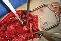 TECH FIG 9  Saphenous nerve neuroma and small anterior branch