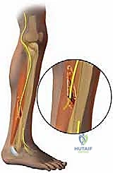 TECH FIG 6  Drilling unicortical hole in fibula for transected superior peroneal nerve ending