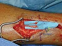 TECH FIG 9  Saphenous nerve neuroma and small anterior branch