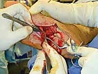 FIG 4  Simple bulb neuroma after sural nerve resection