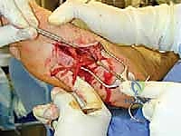 TECH FIG 10  Dissection of the medial plantar nerve and branches