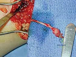 FIG 4  Simple bulb neuroma after sural nerve resection