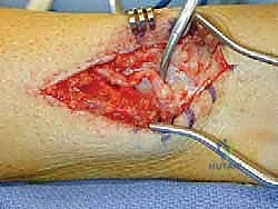 FIG 5  Previous burial of superior peroneal nerve into bone with mild neuritis and small more proximal branch