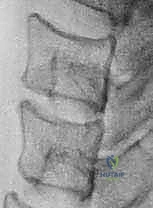 تفاصيل دقيقة لعملية ACDF