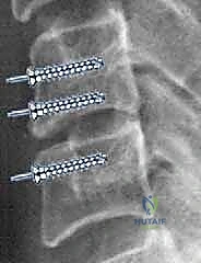 زراعة القفص والطعم العظمي