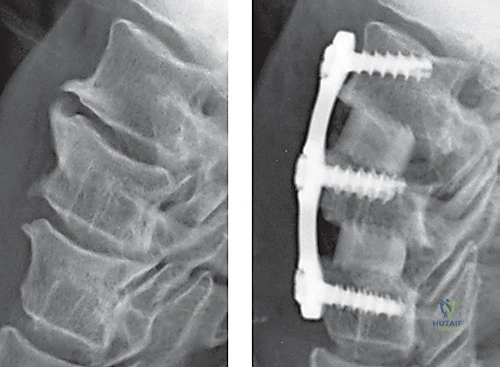 تشريح العمود الفقري العنقي
