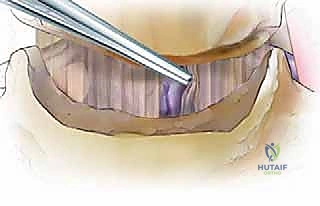 Anterior Cervical Discectomy and Fusion: An Intraoperative Masterclass