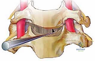صورة طبية: عملية استئصال القرص العنقي الأمامي ودمج الفقرات (ACDF) دليل شامل من الأستاذ الدكتور محمد هطيف