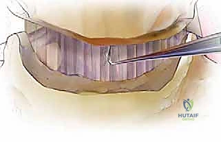 صورة توضيحية لـ عملية استئصال القرص العنقي الأمامي ودمج الفقرات (ACDF) دليل شامل من الأستاذ الدكتور محمد هطيف