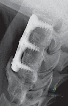 صورة توضيحية لـ عملية استئصال القرص العنقي الأمامي ودمج الفقرات (ACDF) دليل شامل من الأستاذ الدكتور محمد هطيف