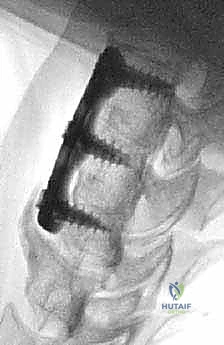 عملية استئصال القرص العنقي الأمامي ودمج الفقرات (ACDF) دليل شامل من الأستاذ الدكتور محمد هطيف