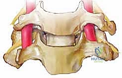 صورة طبية: عملية استئصال القرص العنقي الأمامي ودمج الفقرات (ACDF) دليل شامل من الأستاذ الدكتور محمد هطيف