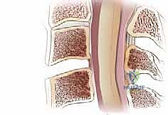 صورة توضيحية لـ عملية استئصال القرص العنقي الأمامي ودمج الفقرات (ACDF) دليل شامل من الأستاذ الدكتور محمد هطيف