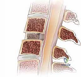 مراحل استئصال القرص العنقي