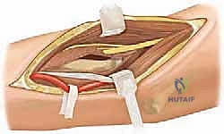 صورة طبية: كسور رأس وعنق الكعبرة: دليل شامل للتشخيص والعلاج والتعافي في صنعاء مع الأستاذ الدكتور محمد هطيف