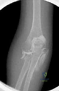 صورة طبية: كسور رأس وعنق الكعبرة: دليل شامل للتشخيص والعلاج والتعافي في صنعاء مع الأستاذ الدكتور محمد هطيف