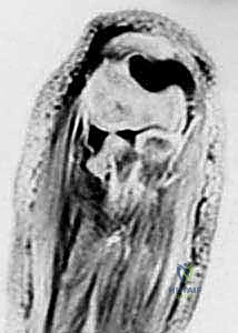صورة طبية: كسور رأس وعنق الكعبرة: دليل شامل للتشخيص والعلاج والتعافي في صنعاء مع الأستاذ الدكتور محمد هطيف