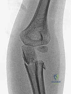 صورة طبية: كسور رأس وعنق الكعبرة: دليل شامل للتشخيص والعلاج والتعافي في صنعاء مع الأستاذ الدكتور محمد هطيف