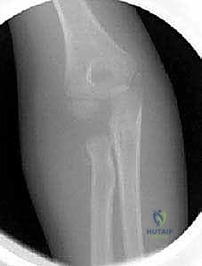 صورة طبية: كسور رأس وعنق الكعبرة: دليل شامل للتشخيص والعلاج والتعافي في صنعاء مع الأستاذ الدكتور محمد هطيف