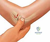 صورة توضيحية لـ كسور رأس وعنق الكعبرة: دليل شامل للتشخيص والعلاج والتعافي في صنعاء مع الأستاذ الدكتور محمد هطيف