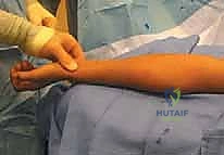 تقييم خيارات الجراحة بناءً على شكل الكسر