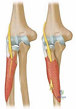 صورة توضيحية لـ كسور رأس وعنق الكعبرة: دليل شامل للتشخيص والعلاج والتعافي في صنعاء مع الأستاذ الدكتور محمد هطيف