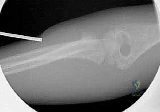 صورة توضيحية لـ كسور رأس وعنق الكعبرة: دليل شامل للتشخيص والعلاج والتعافي في صنعاء مع الأستاذ الدكتور محمد هطيف