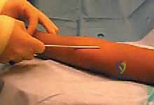 آلية السقوط وتأثيرها على مفصل المرفق