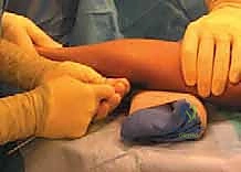 تقييم زاوية الكسر في عنق الكعبرة