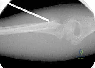 التصوير الشعاعي المتقدم لتقييم الكسر