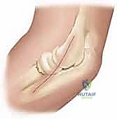 التحضير لعملية الرد المغلق في غرفة العمليات