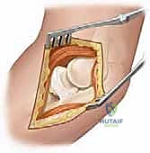 Illustration of percutaneous and open - Dr. Mohammed Hutaif