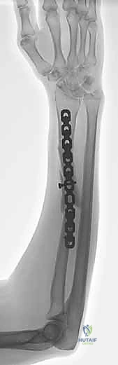 تشريح عظام الساعد