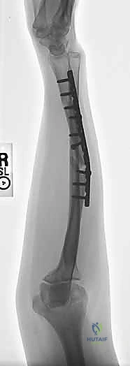 سوء التئام الساعد وعلاجه