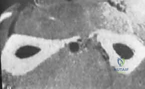 تأثير سوء الالتئام على الحركة