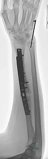 Corrective Osteotomy for Forearm Diaphyseal Malunions: An Intraoperative Masterclass