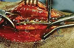 صورة توضيحية لـ قطع العظم التصحيحي لسوء التئام الساعد: استعادة الوظيفة والحركة بيد الأستاذ الدكتور محمد هطيف