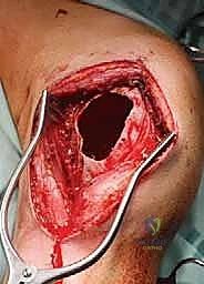 فتح نافذة عظمية للوصول إلى الورم بدقة