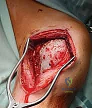 صورة توضح تدمير العظم السليم بسبب الأورام العدوانية