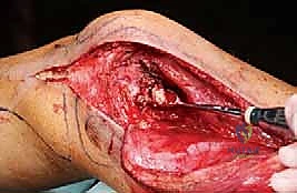 مراقبة درجات الحرارة بدقة أثناء إجراء الاستئصال بالتبريد