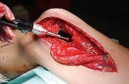 الكشط الجراحي وإزالة أنسجة الورم بالكامل