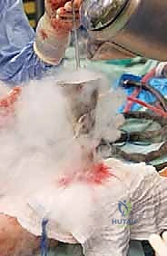 صورة توضيحية لـ الاستئصال بالتبريد لأورام العظام: دليل شامل للمرضى مع الأستاذ الدكتور محمد هطيف