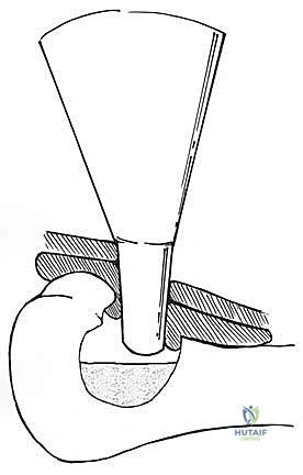 تخطيط جراحي دقيق لأورام العظام في عيادة الدكتور محمد هطيف