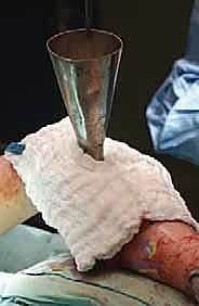 الاستئصال بالتبريد لأورام العظام: دليل شامل للمرضى مع الأستاذ الدكتور محمد هطيف