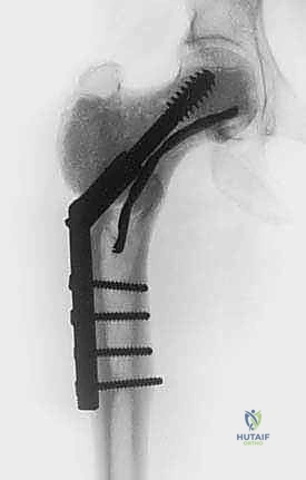 صورة توضيحية لـ الاستئصال بالتبريد لأورام العظام: دليل شامل للمرضى مع الأستاذ الدكتور محمد هطيف